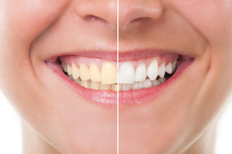 Teeth Whitening in San Jose